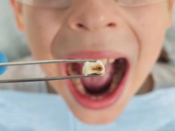 Best Emergency Dental Extractions in Bunnell, FL